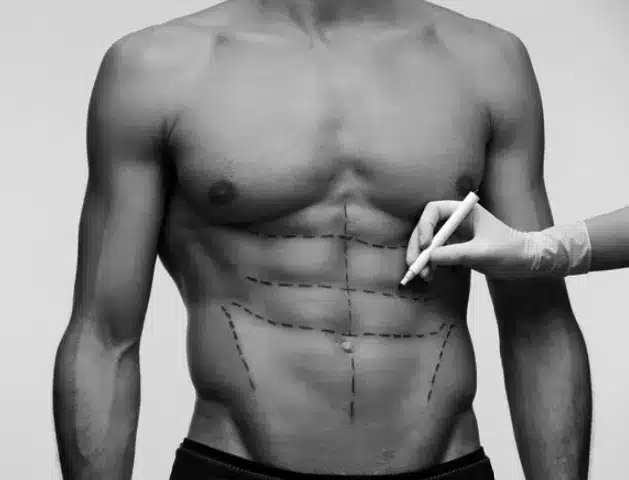 liposuccion homme