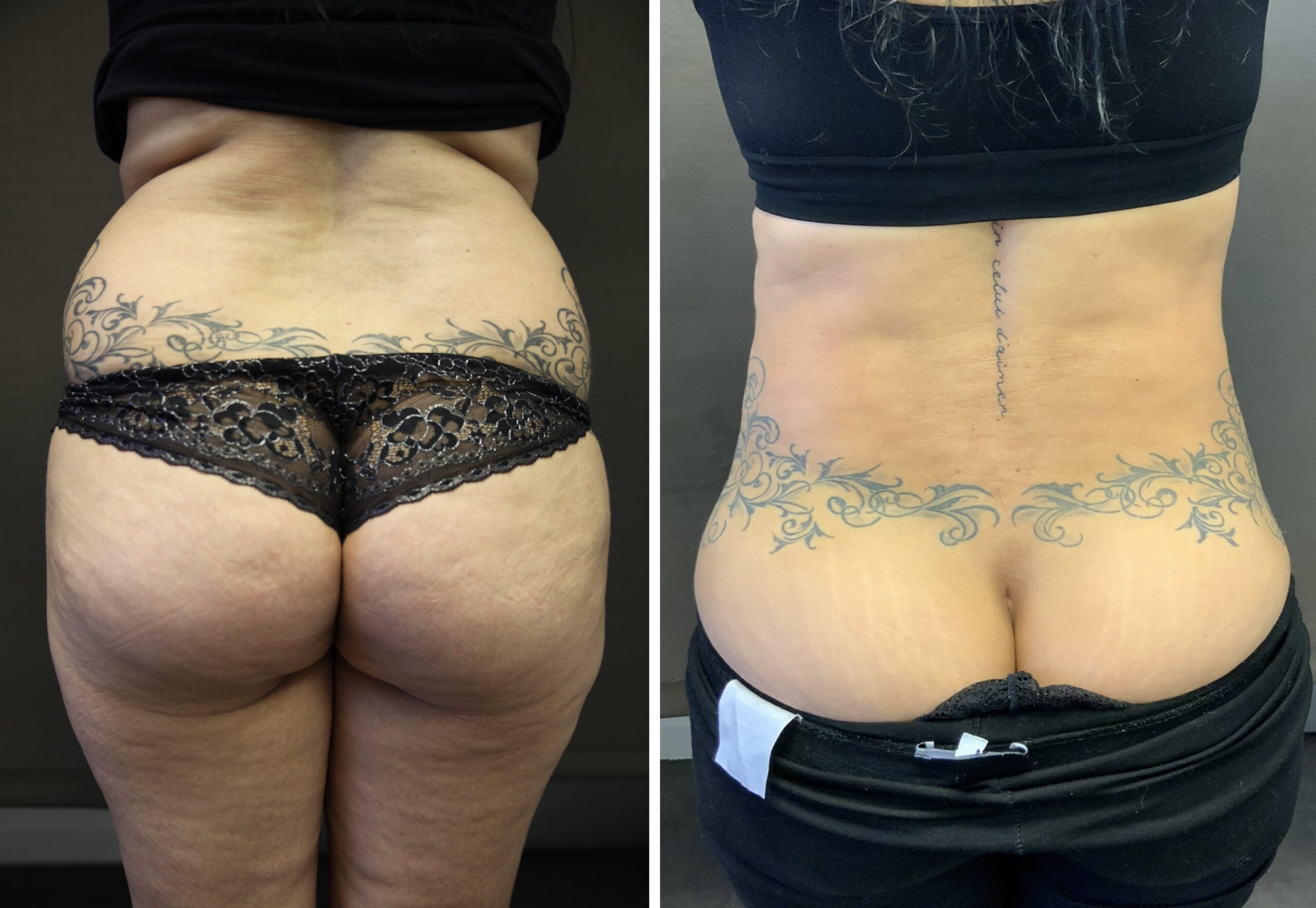 Avant Après Liposculpture lipo liposuccion lipoaspiration ventre dos 360 BBL liposculpture femmes 2