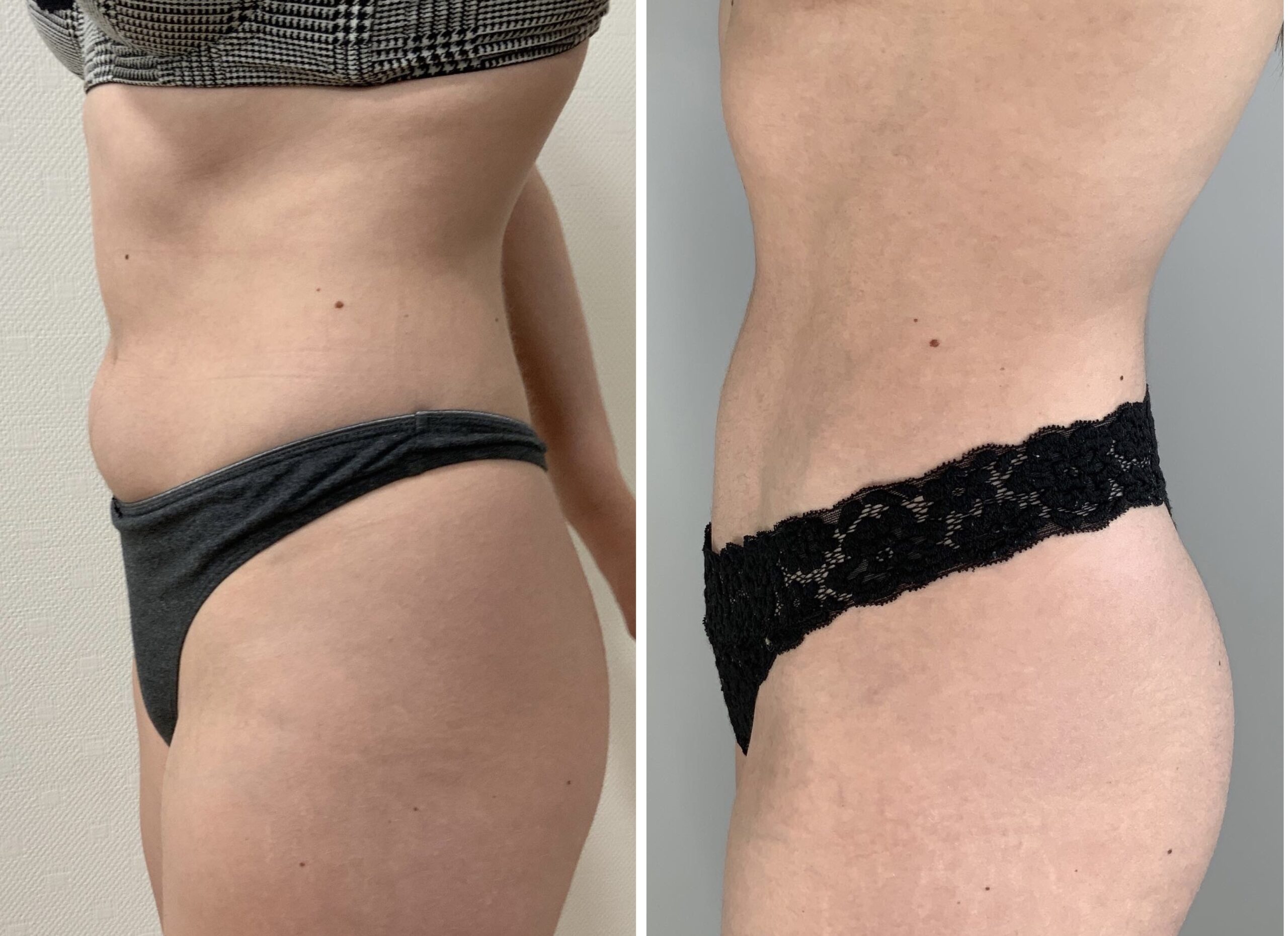Avant Après Liposculpture lipo liposuccion lipoaspiration ventre dos 360 BBL liposculpture femmes 2