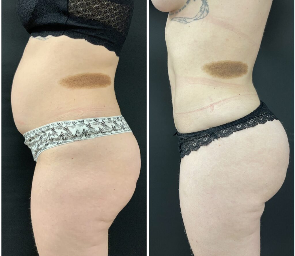 Avant Après Liposculpture lipo liposuccion lipoaspiration ventre dos 360 BBL liposculpture femmes 2