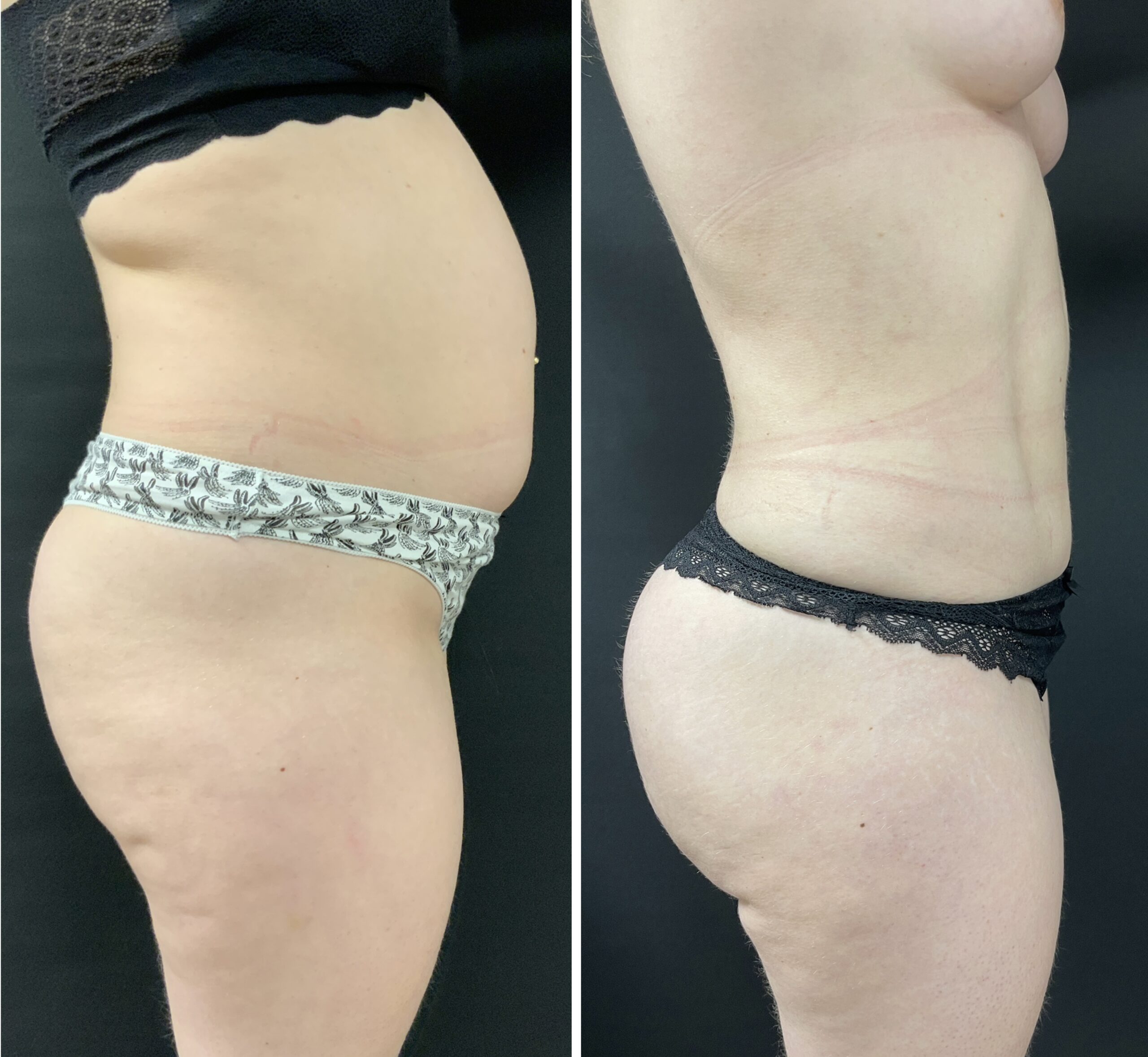 Avant Après Liposculpture lipo liposuccion lipoaspiration ventre dos 360 BBL liposculpture femmes 2