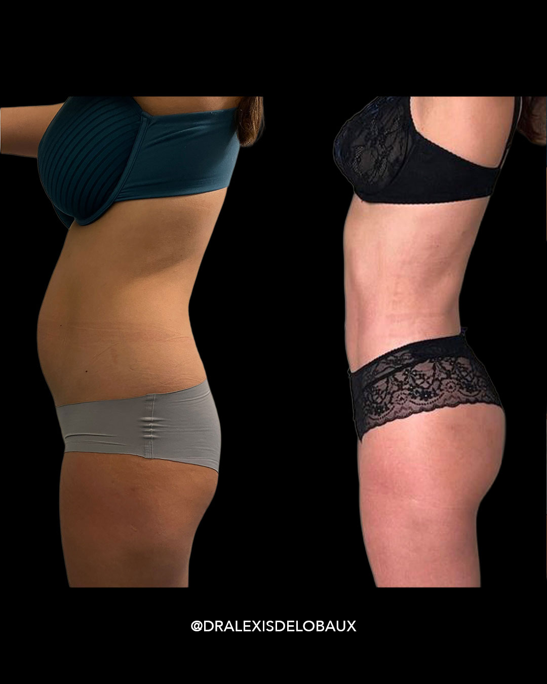 Avant Après Liposculpture lipo liposuccion lipoaspiration ventre dos 360 BBL liposculpture femmes 2