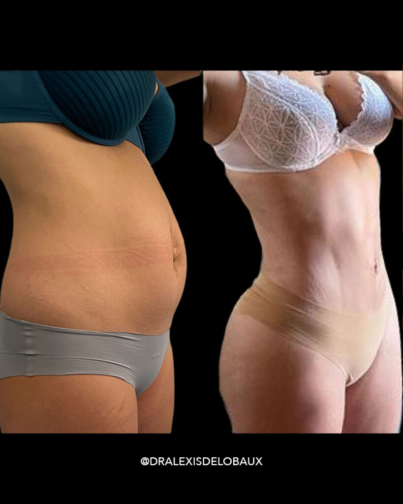 Avant Après Liposculpture 3D liposuccion lipoaspiration ventre dos 360 BBL liposculpture femmes 2