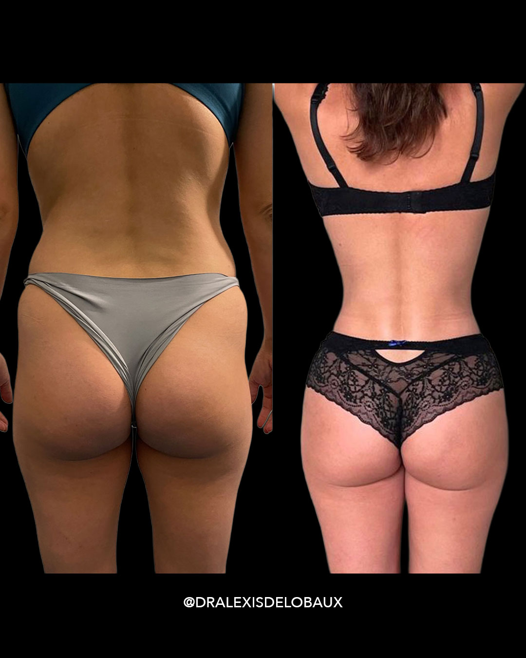 Avant Après Liposculpture lipo liposuccion lipoaspiration ventre dos 360 BBL liposculpture femmes 2 avant APRESNEW 03