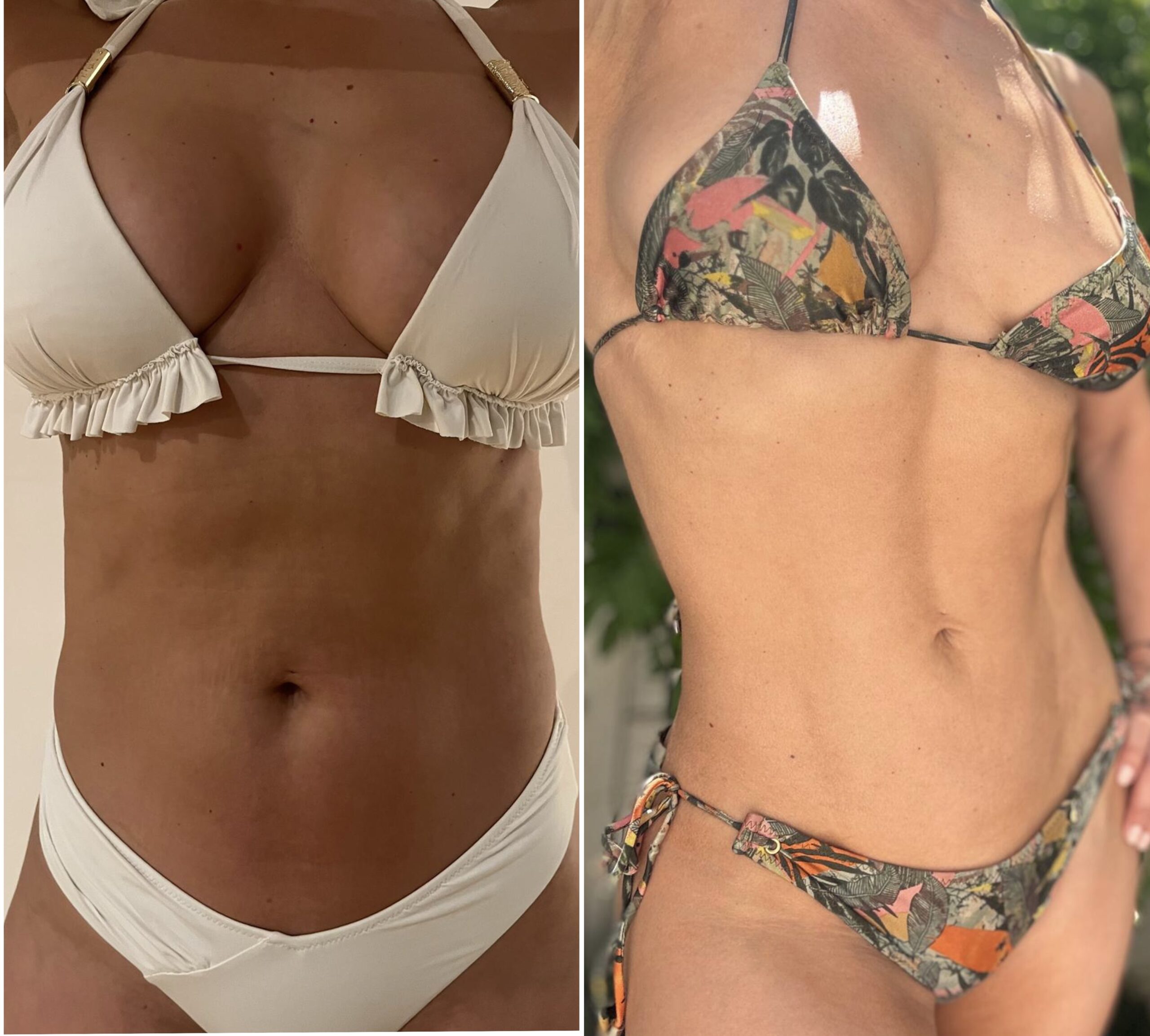 Avant Après Liposculpture lipo liposuccion lipoaspiration ventre dos 360 BBL liposculpture femmes 2
