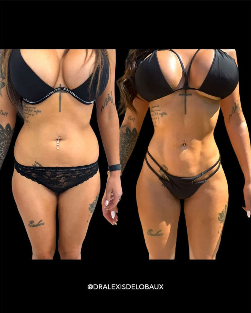 différence liposuccion liposculpture Avant Après Liposculpture ventre dos 360 BBL liposculpture