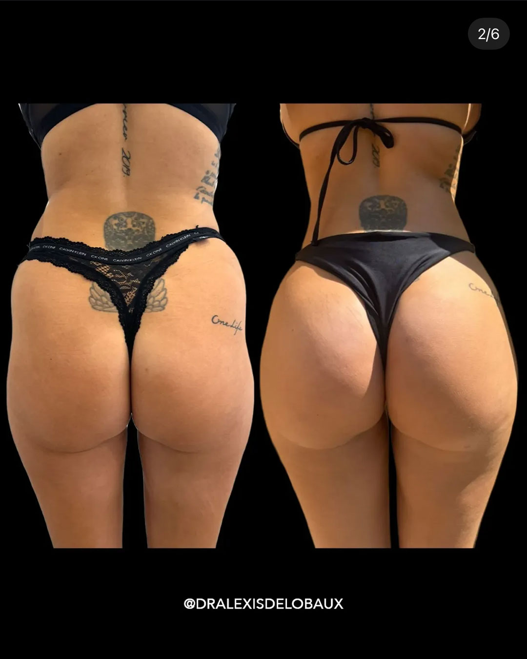 Avant Après Liposculpture lipo liposuccion lipoaspiration ventre dos 360 BBL liposculpture femmes 2